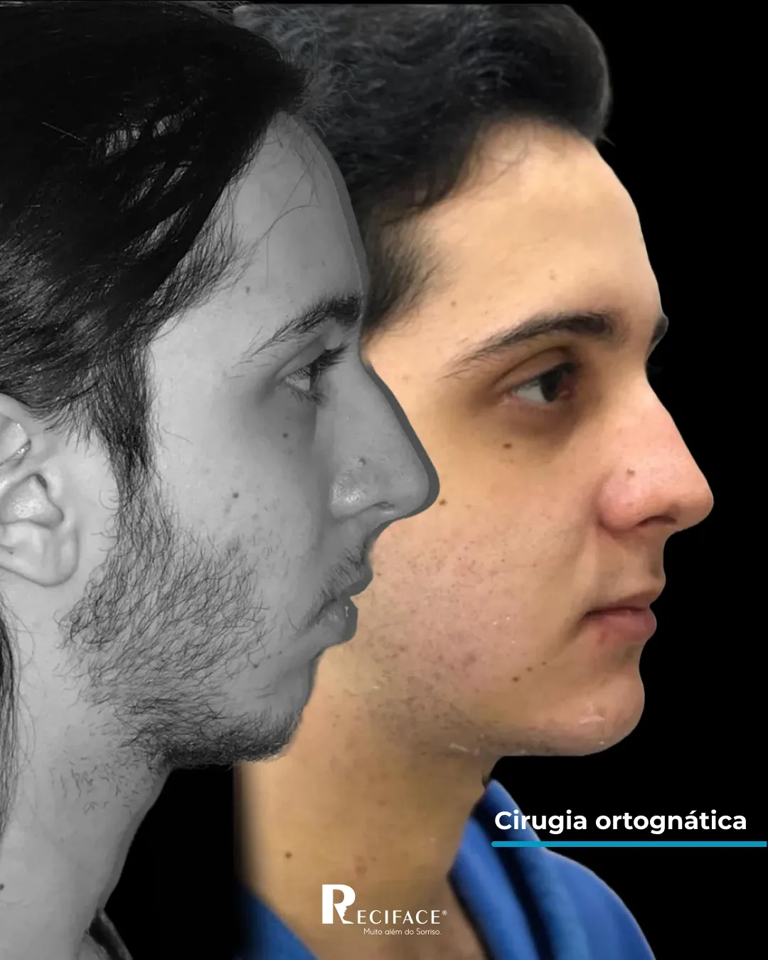 Antes e depois de cirurgia ortognática