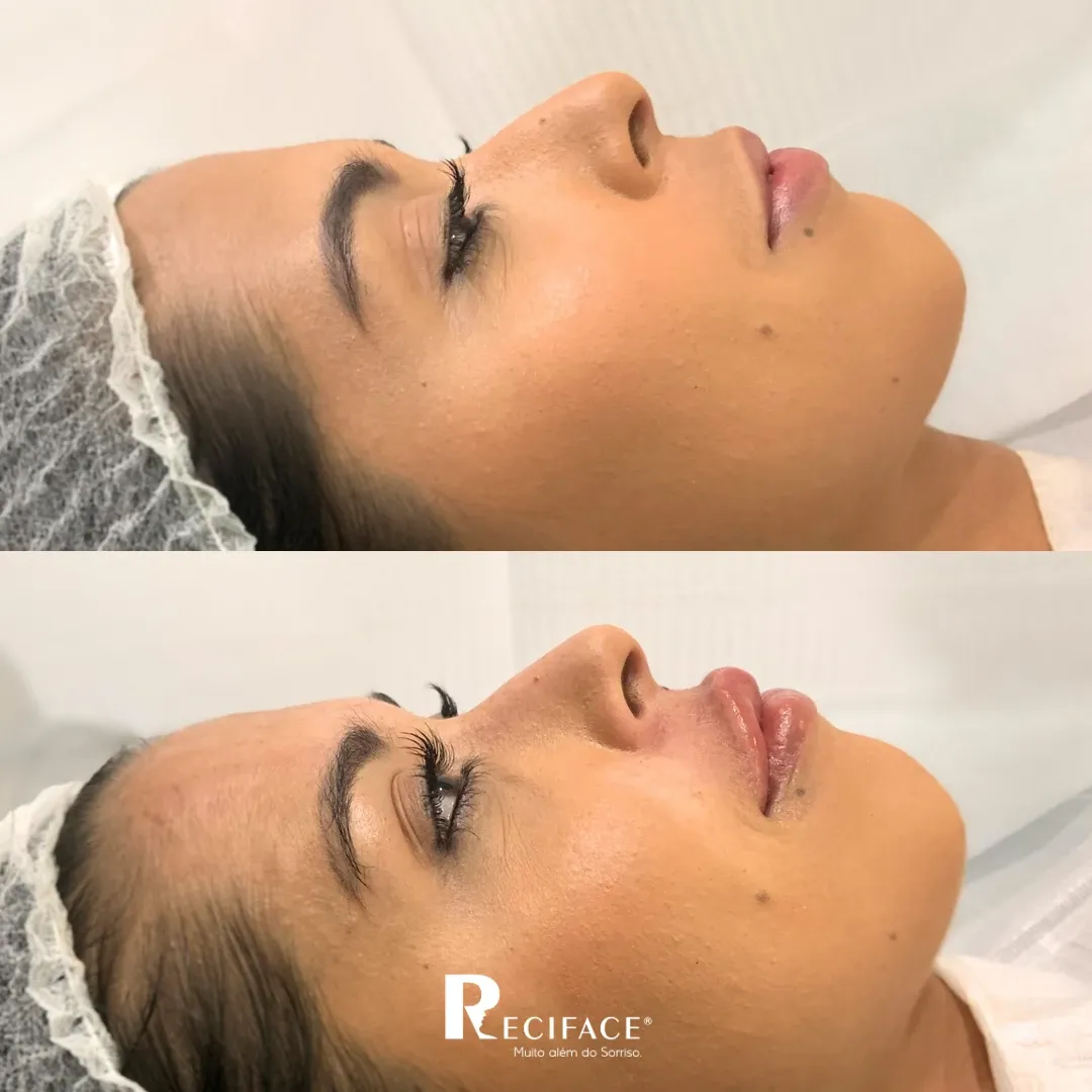 Perfil de paciente antes e depois do preenchimento labial
